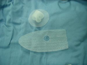 Hernia_mesh_1-300x225